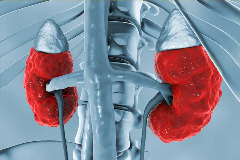 Manage CKD without dialysis - Lucknow Apollo Hospitals