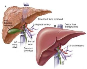 Liver Surgeries & Transplants - All You Need to Know